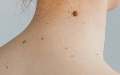 Día Mundial contra el Melanoma:  La importancia de detectar cambios en la piel a tiempo.